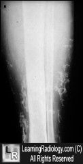 Stasis periosititis